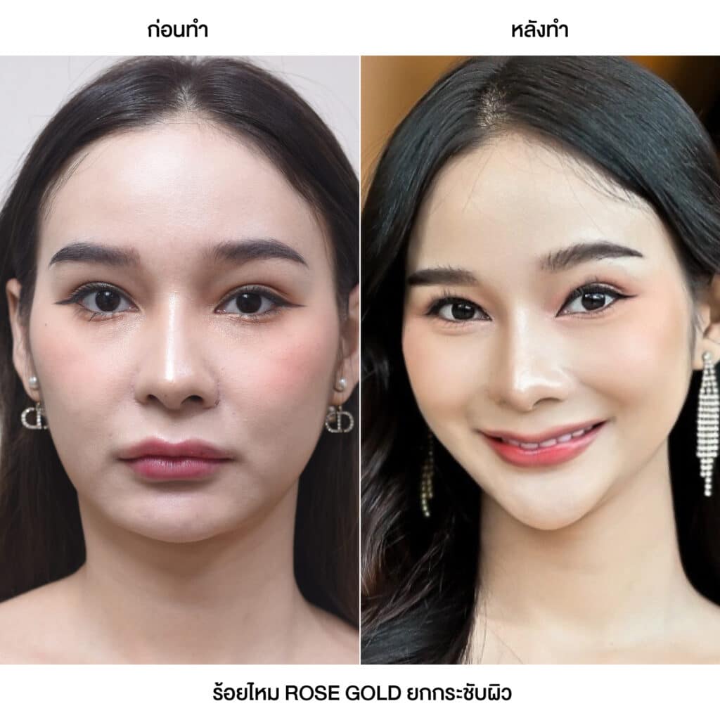 รวมรีวิวลูกค้า ร้อยไหม ROSE GOLD V CONTOUR