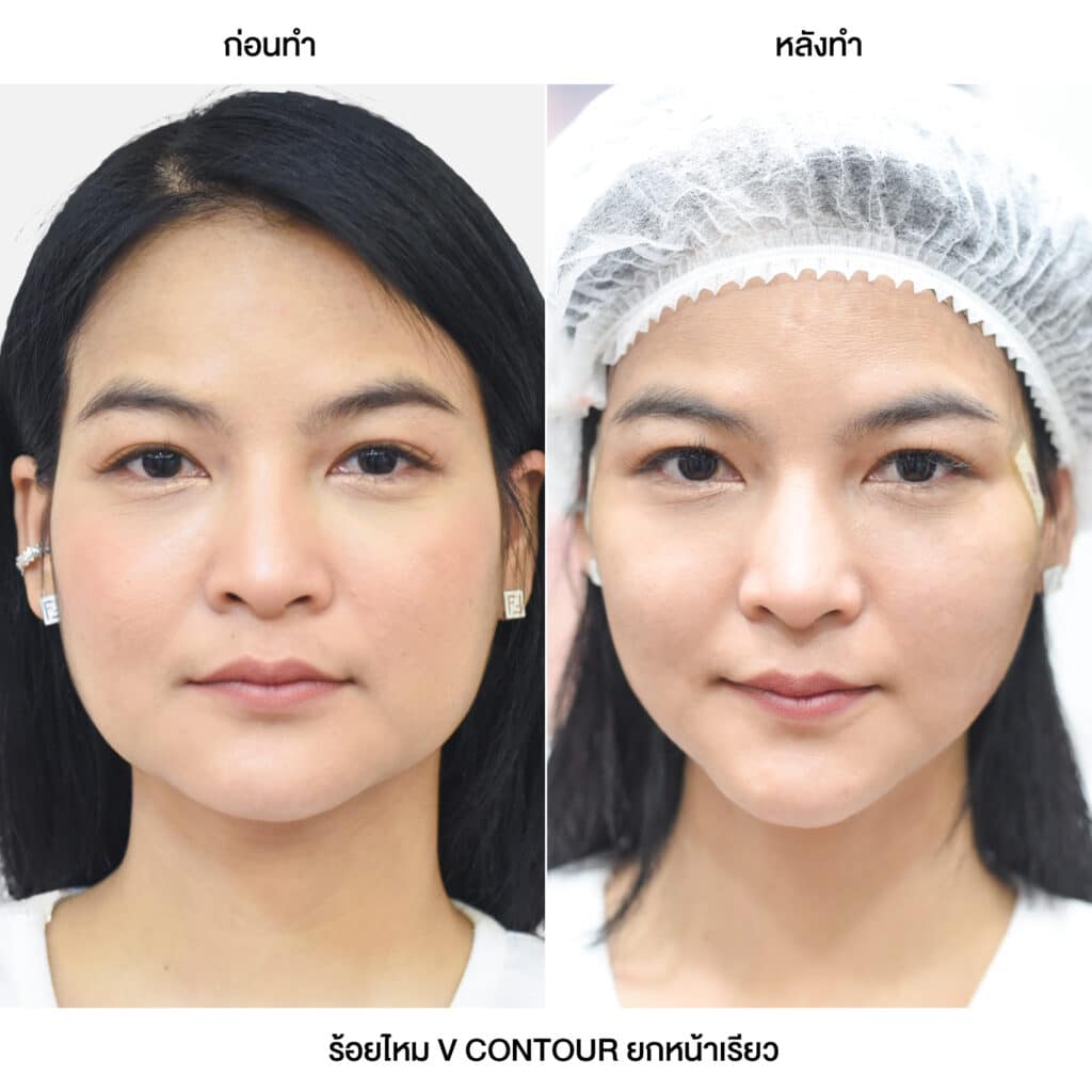 รวมรีวิวลูกค้า ร้อยไหม ROSE GOLD V CONTOUR