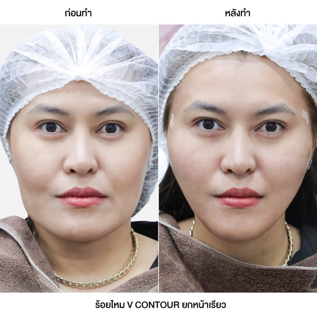 รวมรีวิวลูกค้า ร้อยไหม ROSE GOLD V CONTOUR